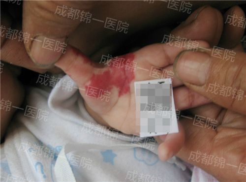 手部血管瘤治疗
