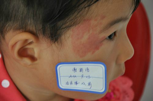 孕妈妈如何预防婴儿鲜红斑痣