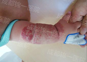 混合性血管瘤